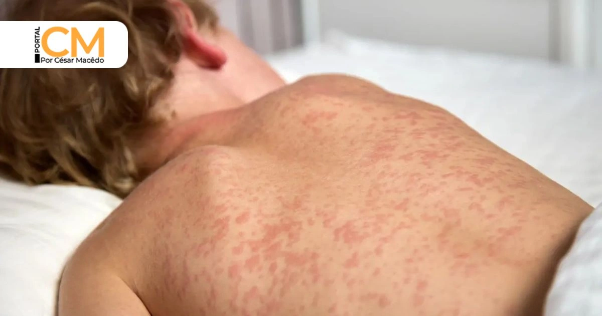 Ceará investiga caso suspeito de sarampo; Sesa diz que doença está sob controle