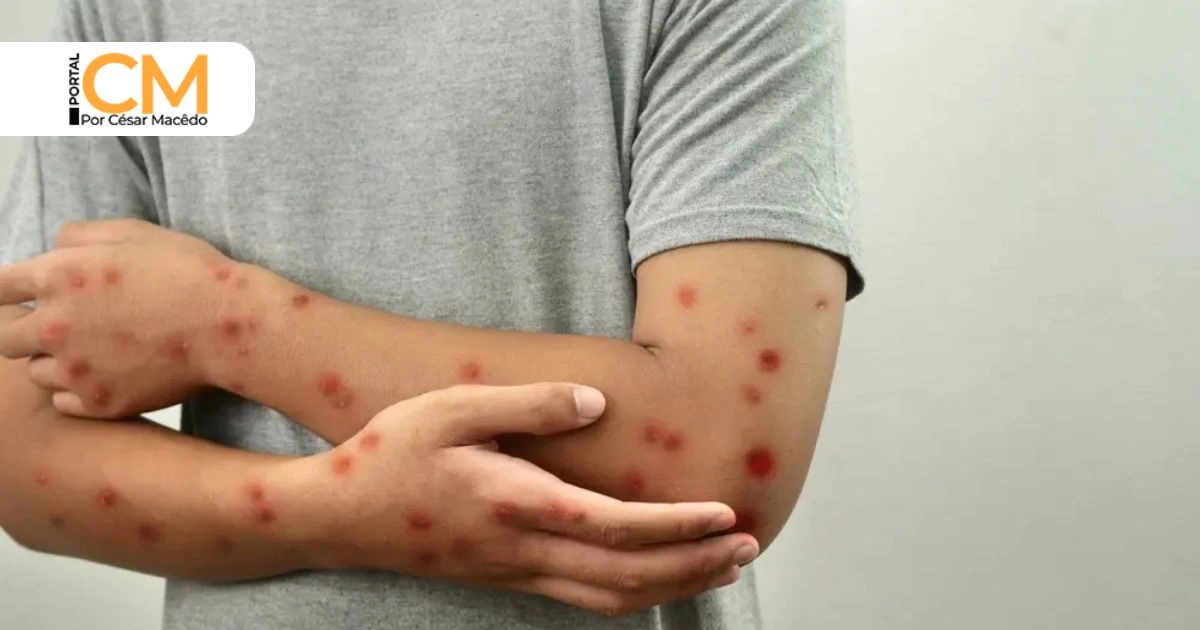 Ceará confirma terceiro caso de Mpox em 2026