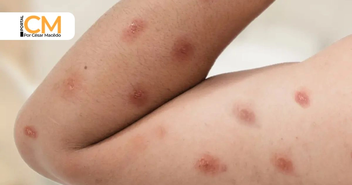 vvvCeará confirma cinco casos de Mpox em 2026